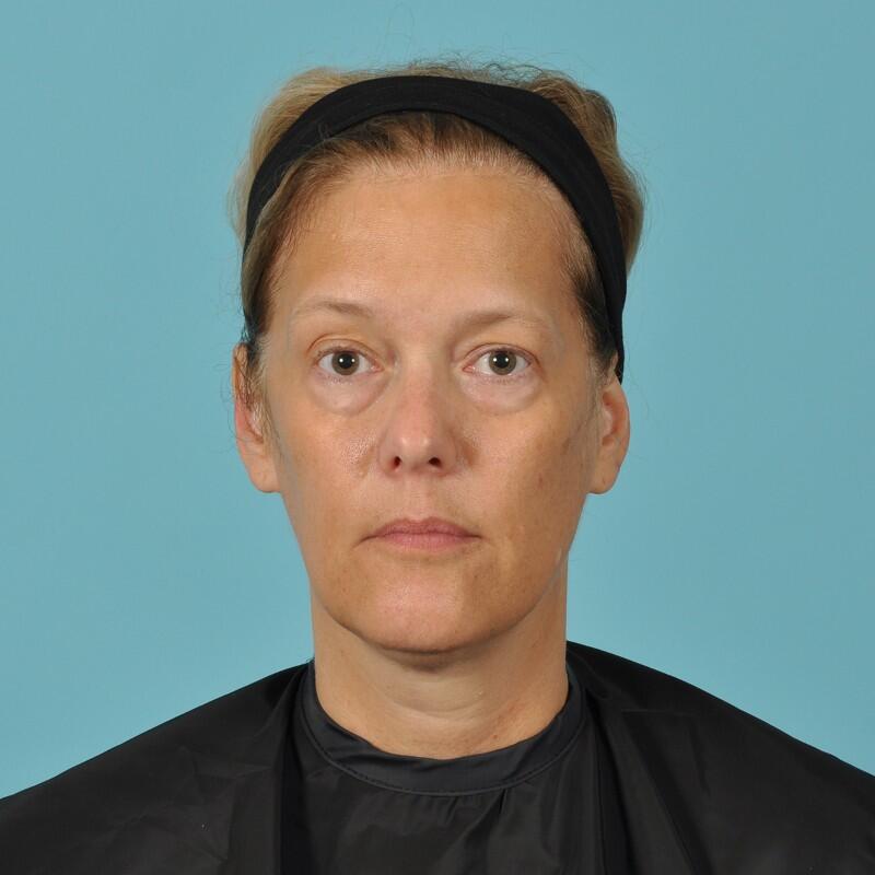 Blepharoplasty Before & After Image Patient 31012