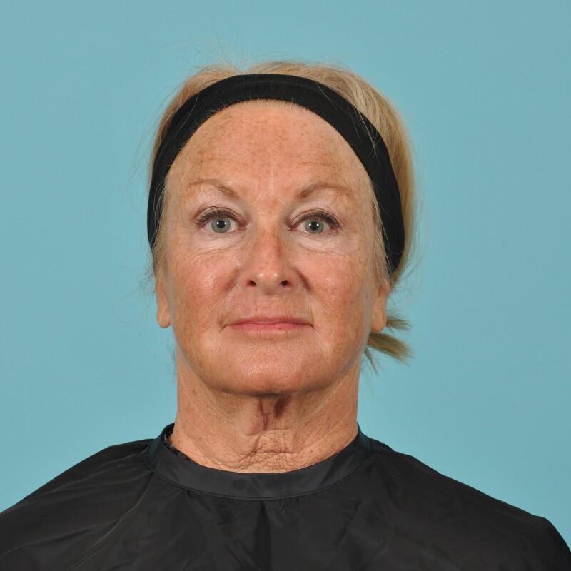 Blepharoplasty Before & After Image Patient 31013
