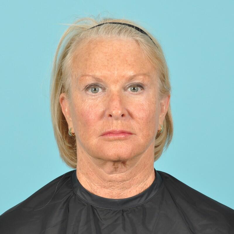 Blepharoplasty Before & After Image Patient 31013