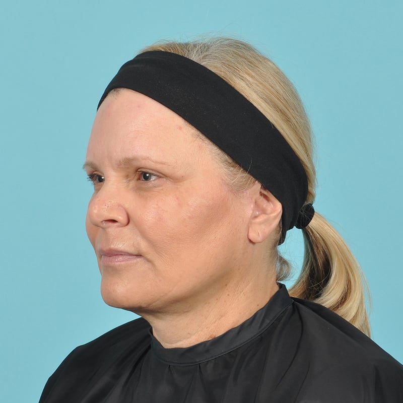 Facelift Before & After Image Patient 16891