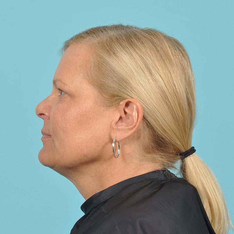 Facelift Before & After Image Patient 16891