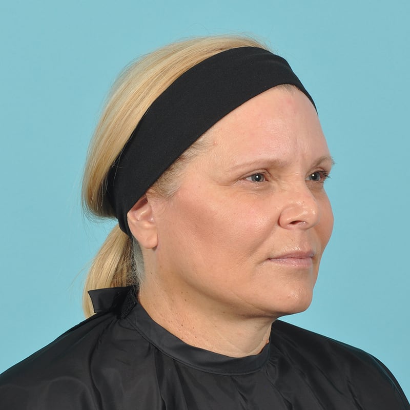 Facelift Before & After Image Patient 16891