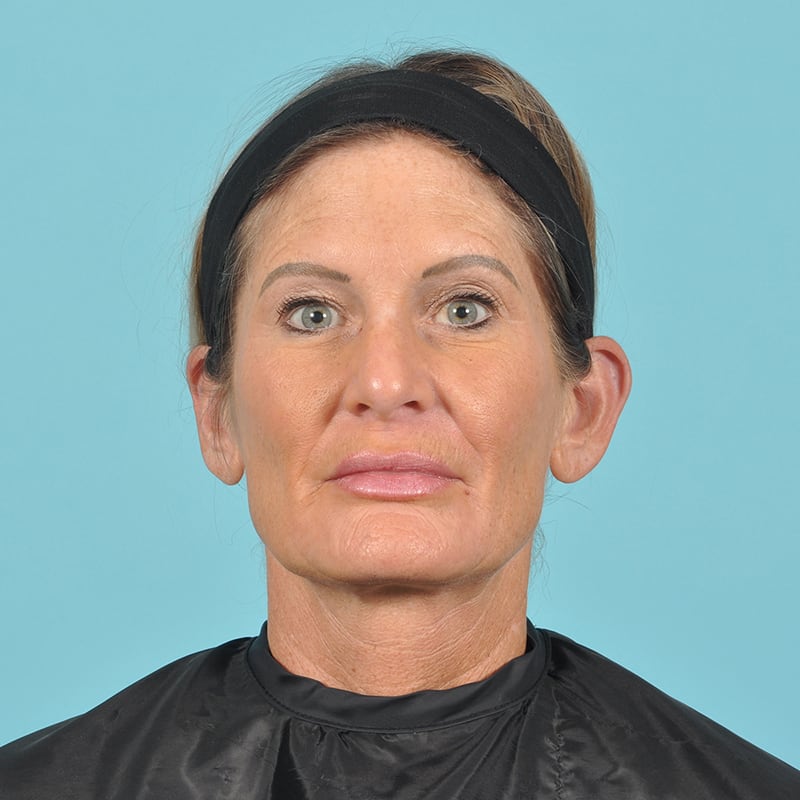 Facelift Before & After Image Patient 21683